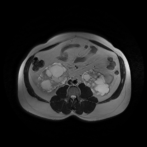 File:Autosomal dominant polycystic kidney disease (Radiopaedia 50259-55611 Axial T2 29).jpg