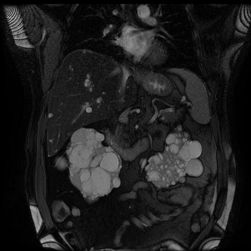 File:Autosomal dominant polycystic kidney disease (Radiopaedia 50259-55611 Coronal FIESTA 17).jpg