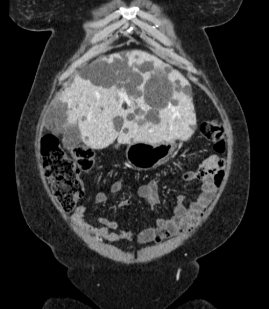 Autosomal dominant polycystic kidney disease (Radiopaedia 57124-64017 B 16).jpg