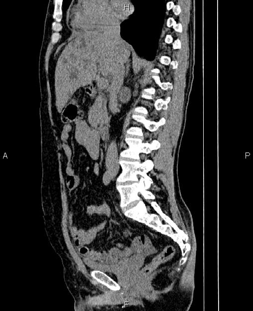 Autosomal dominant polycystic kidney disease (Radiopaedia 87830-104287 C 40).jpg