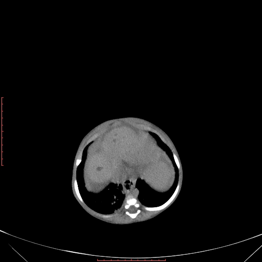 File:Autosomal recessive polycystic kidney disease associated with Caroli disease (Radiopaedia 61932-69984 Axial non-contrast 100).jpg