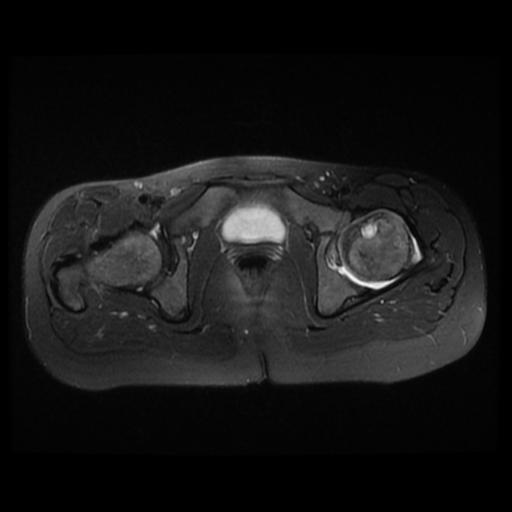 File:Avascular necrosis of the hip (Radiopaedia 29563-30067 Axial T2 fat sat 10).jpg
