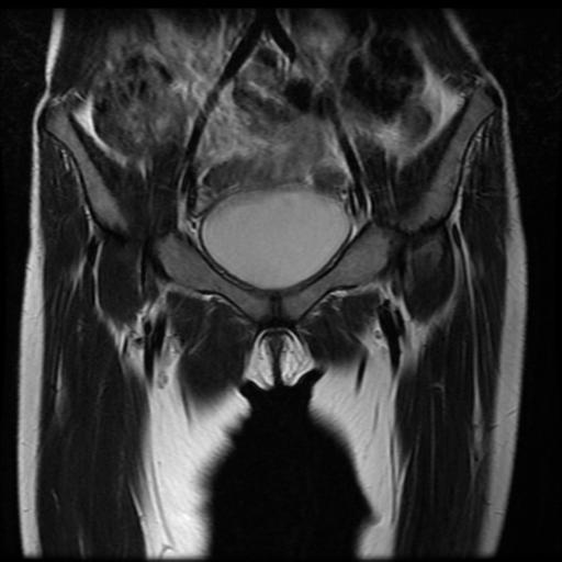 File:Avascular necrosis of the hip (Radiopaedia 29563-30067 Coronal T2 2).jpg