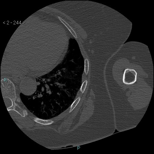 Avascular necrosis of the shoulder - Cruess stage I (Radiopaedia 77674-89887 Axial bone window 61).jpg