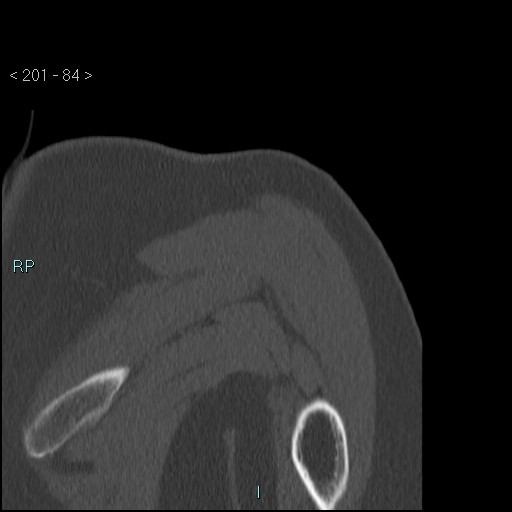 Avascular necrosis of the shoulder - Cruess stage I (Radiopaedia 77674-89887 Coronal bone window 83).jpg
