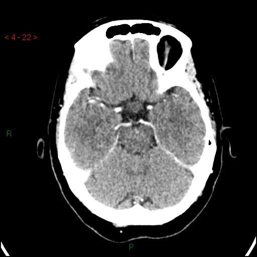 Azygos anterior cerebral artery (Radiopaedia 51987-57833 A 22).jpg