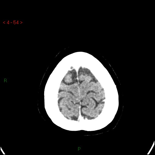 Azygos anterior cerebral artery (Radiopaedia 51987-57833 A 54).jpg
