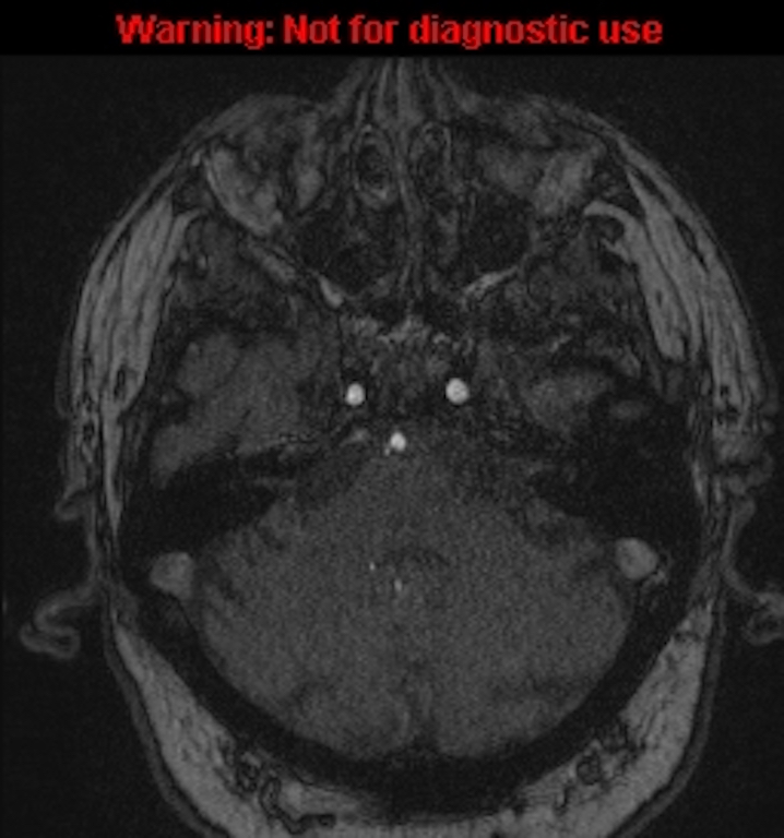 Azygos anterior cerebral artery (Radiopaedia 59325-66677 Axial MRA 35).jpg