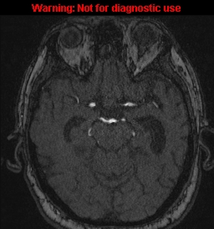 Azygos anterior cerebral artery (Radiopaedia 59325-66677 Axial MRA 64).jpg