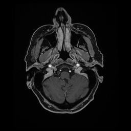 Balo concentric sclerosis (Radiopaedia 53875-59982 Axial LAVA C+ 46).jpg