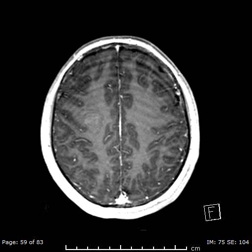 Balo concentric sclerosis (Radiopaedia 61637-69636 Axial T1 C+ 59).jpg