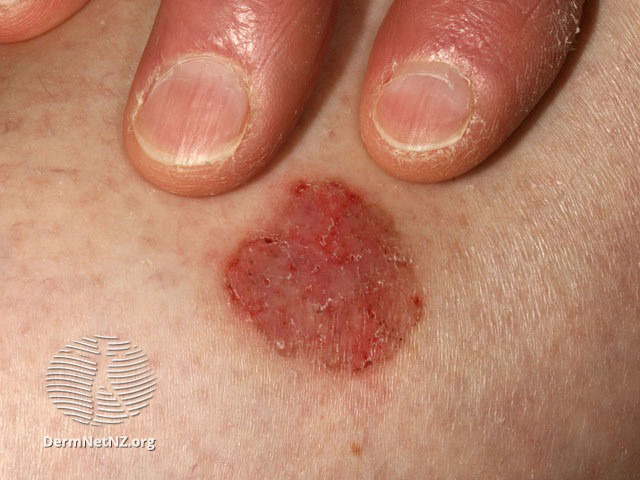 File:Basal cell carcinoma affecting the trunk (DermNet NZ lesions-bcc-trunk-0653).jpg