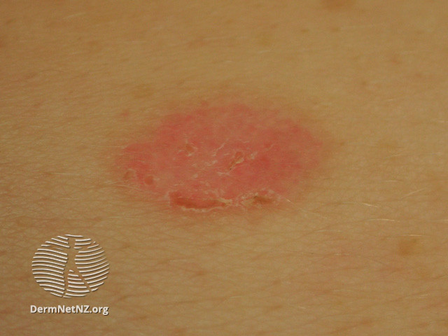 File:Basal cell carcinoma affecting the trunk (DermNet NZ lesions-bcc-trunk-0752).jpg
