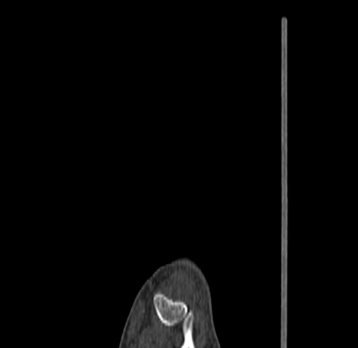 Base of 2nd metacarpal fracture (Radiopaedia 73741-84544 Sagittal bone window 21).jpg