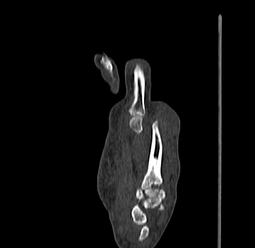 Base of 2nd metacarpal fracture (Radiopaedia 73741-84544 Sagittal bone window 50).jpg