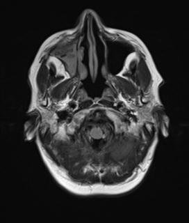 File:Base of skull chondrosarcoma (Radiopaedia 30410-31070 Axial FLAIR 2).jpg