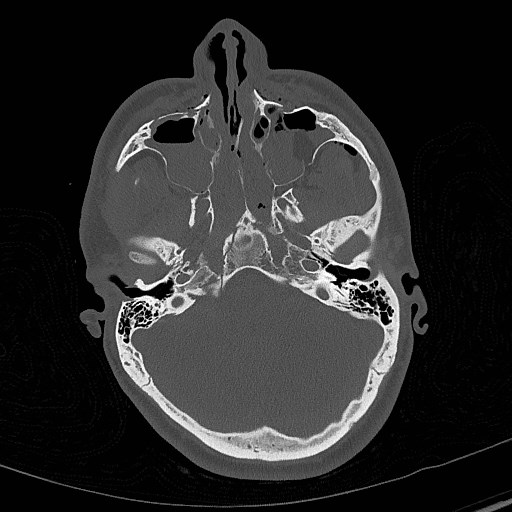 File:Base of skull fracture with bilateral Le Fort fractures (Radiopaedia 47094-51638 Axial bone window 27).jpg