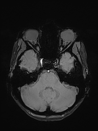 File:Basilar artery perforator aneurysm (Radiopaedia 82455-97733 Axial SWI 13).jpg
