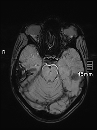 Basilar artery perforator aneurysm (Radiopaedia 82455-99523 Axial SWI 22).jpg