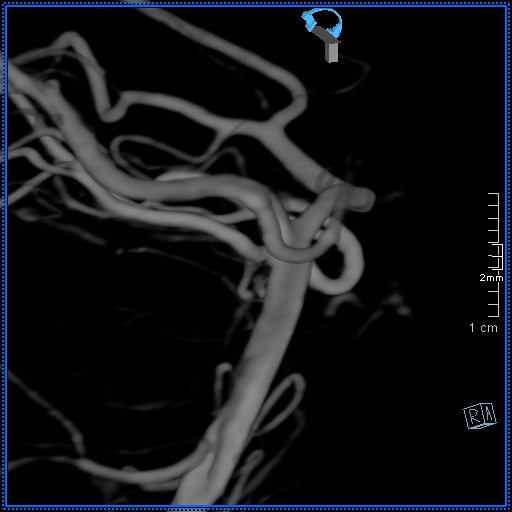 Basilar artery perforator aneurysm (Radiopaedia 82455-99524 3D Left VA 57).jpg