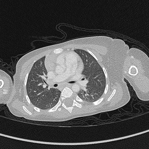 File:Beckwith-Wiedeman syndrome with bilateral Wilms tumors (Radiopaedia 60850-68629 Axial lung window 29).jpg