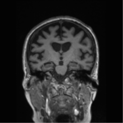 Behavioral variant frontotemporal dementia and late onset schizophrenia (Radiopaedia 52197-58083 Coronal T1 50).png