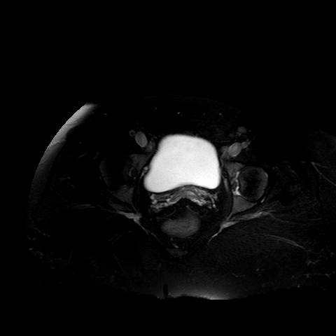 File:Benign seromucinous cystadenoma of the ovary (Radiopaedia 71065-81300 T2 SPAIR 5).jpg