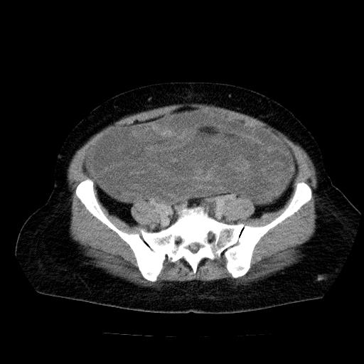 Benign spindle cell tumor - abdominopelvic (Radiopaedia 61300-69212 Axial C+ delayed 46).jpg