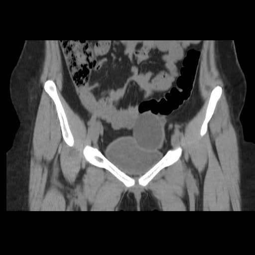 File:Bicornuate uterus- on MRI (Radiopaedia 49206-54296 Coronal non-contrast 5).jpg