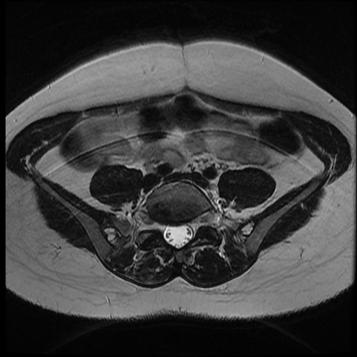 File:Bicornuate uterus (Radiopaedia 51676-57472 Axial T2 32).jpg