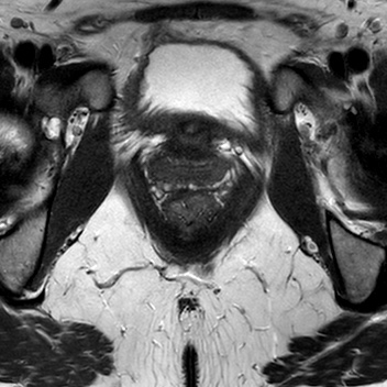 File:Bicornuate uterus (Radiopaedia 61974-70046 Axial T2 25).jpg