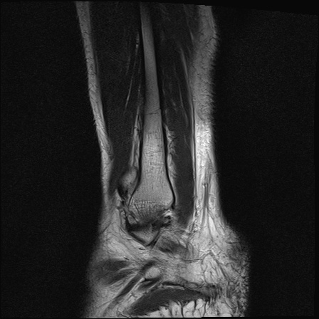 File:Bilateral Achilles tendon complete tear (Radiopaedia 81344-95051 Sagittal T2 3).jpg