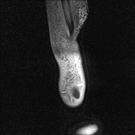 Bilateral Achilles tendon complete tear (Radiopaedia 81344-95051 Sagittal WE - Right 10).jpg