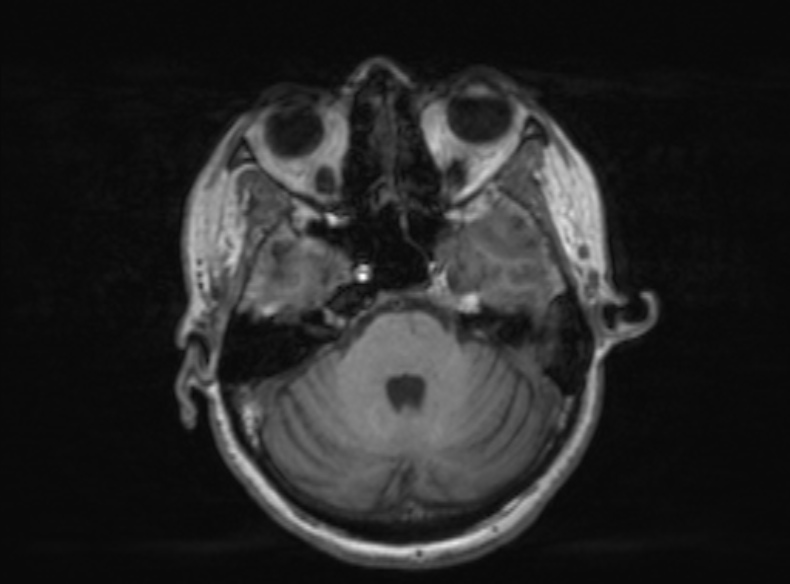 Bilateral PCA territory infarction - different ages (Radiopaedia 46200-51784 Axial T1 297).jpg