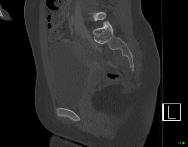 Bilateral acetabular fractures (Radiopaedia 79272-92308 Sagittal bone window 39).jpg