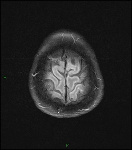 File:Bilateral acute middle cerebral artery territory infarcts (Radiopaedia 77319-89402 Axial FLAIR 22).jpg