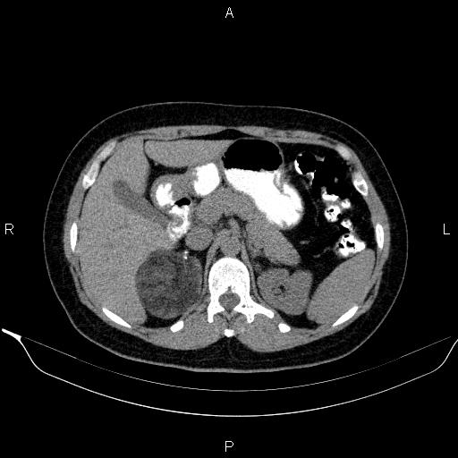Bilateral adrenal myelolipoma (Radiopaedia 63058-71535 Axial non-contrast 49).jpg