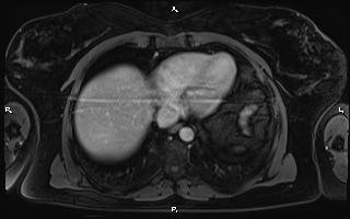 Bilateral adrenal myelolipoma (Radiopaedia 63058-71537 G 11).jpg