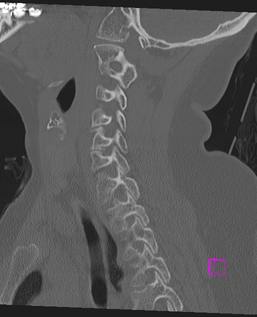 Bilateral atlanto-occipital assimilation (Radiopaedia 28350-28603 Sagittal bone window 49).jpg