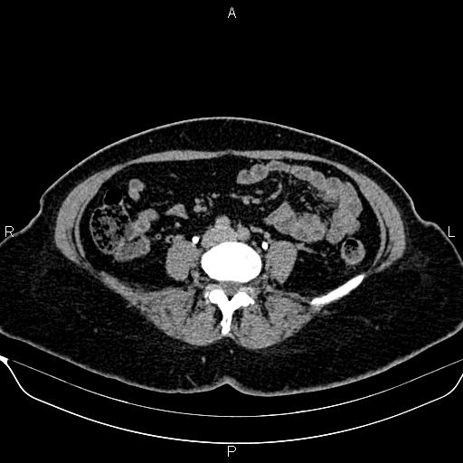 Bilateral benign adrenal adenomas (Radiopaedia 86912-103124 Axial C+ delayed 100).jpg