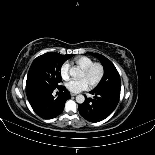 Bilateral benign adrenal adenomas (Radiopaedia 86912-103124 B 2).jpg