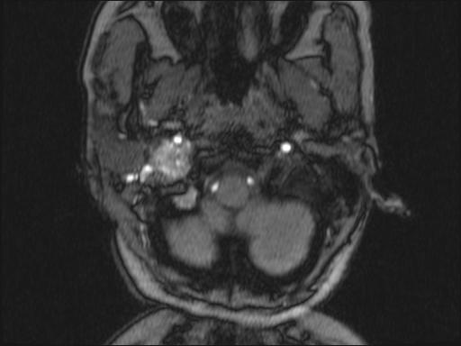 Bilateral carotid body tumors and right glomus jugulare tumor (Radiopaedia 20024-20060 Axial MRA 301).jpg