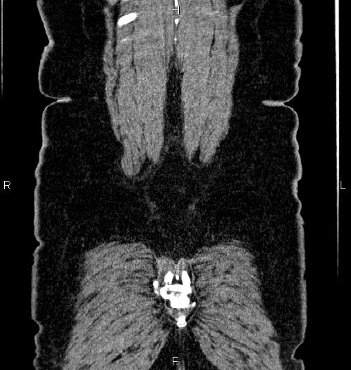 File:Bilateral ovarian dermoid cysts (Radiopaedia 85785-101603 C 61).jpg
