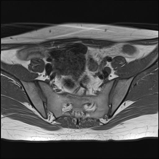 File:Bilateral ovarian endometriomas (Radiopaedia 87085-103347 Axial T1 5).jpg