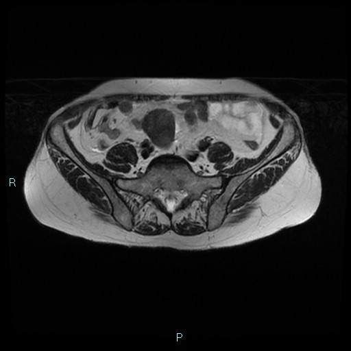File:Bilateral ovarian fibroma (Radiopaedia 44568-48293 Axial T2 4).jpg
