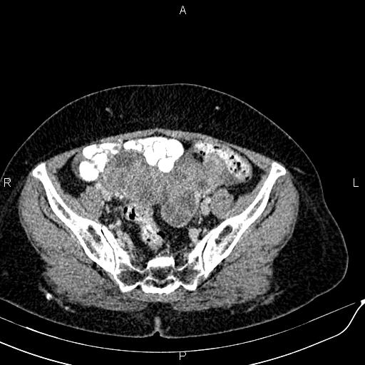 Bilateral ovarian serous cystadenocarcinoma (Radiopaedia 86062-101989 B 82).jpg