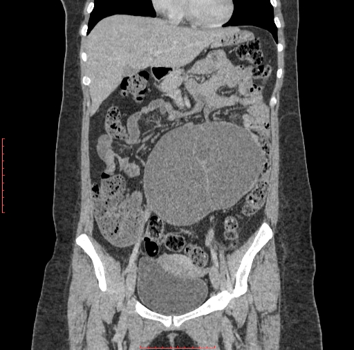 File:Bilateral ovarian serous cystadenocarcinoma with right ovarian torsion (Radiopaedia 32640-33611 B 14).jpg