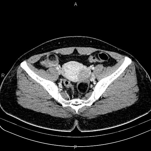 Bilateral ovarian teratoma (Radiopaedia 83131-97503 Axial With contrast 36).jpg