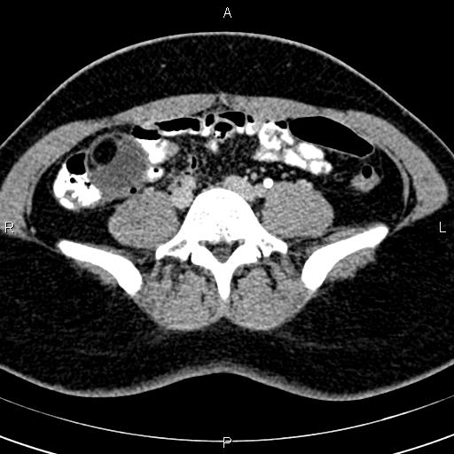 Bilateral ovarian teratoma (Radiopaedia 83131-97503 B 6).jpg