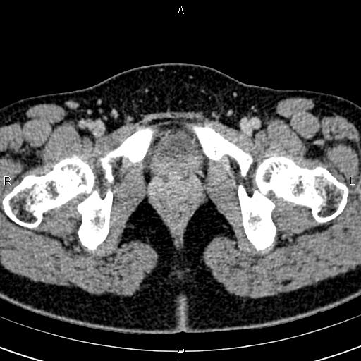 Bilateral ovarian teratoma (Radiopaedia 83131-97503 B 77).jpg